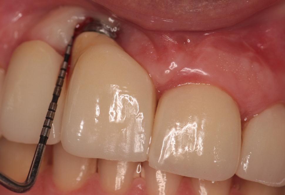 36 Para avaliação do nível de higiene bucal, foram utilizados os seguintes índices: Índice de Placa Visível (IPV): com os implantes e dentes previamente secos, os valores foram atribuídos de forma