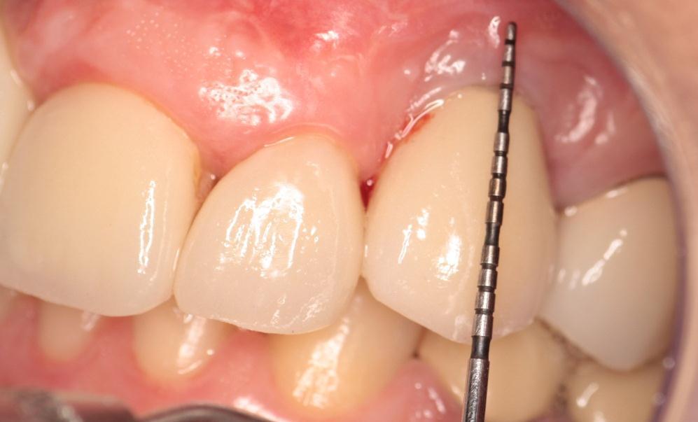 37 Figura 6 - Mensuração da faixa de mucosa queratinizada associada ao implante dentário na região do elemento 22. Fonte: Dados da Pesquisa (NATAL/RN, 2012). 4.