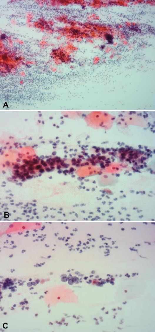 No seguimento clínico, a paciente foi submetida a uma conização, cujo exame histológico revelou a presença de células displásicas em toda a espessura do epitélio e nas glândulas endocervicais (Fig.