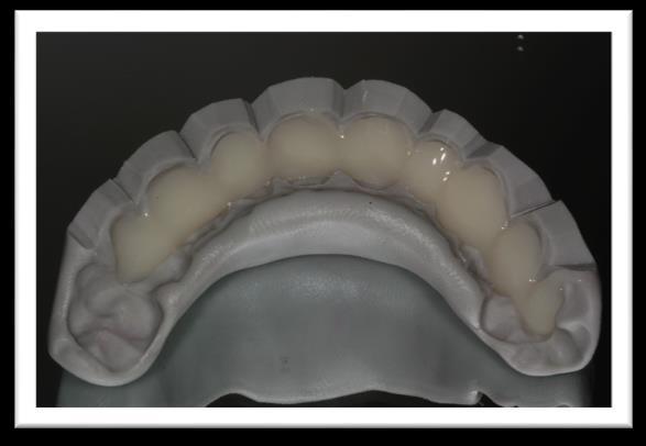 A técnica é baseada na moldagem do enceramento diagnóstico com silicone de condensação e, posteriormente, a matriz obtida é preenchida com a resina bis-acryl, levada em