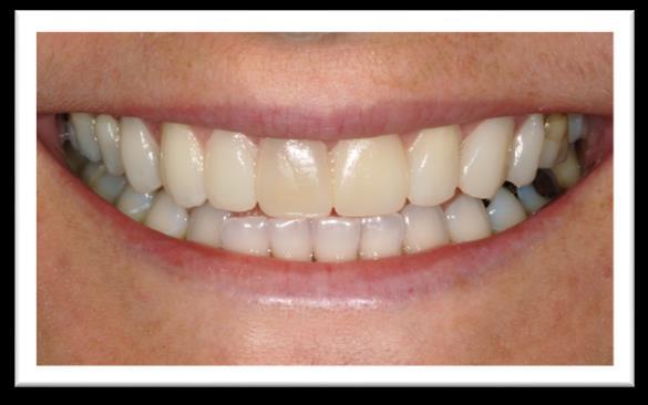 É muito importante salientar que os ensaios devem ser realizados sem condicionamento ácido dos elementos dentários, para que ao final da avaliação, a resina possa ser