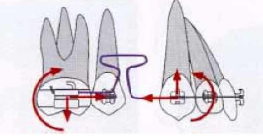 Introdução e Revisão da Literatura sistema de forças e momentos gerados pelo modelo de alça estudado, bem como seu As alças de retração ortodôntica podem ser utilizadas por meio de uma abordagem