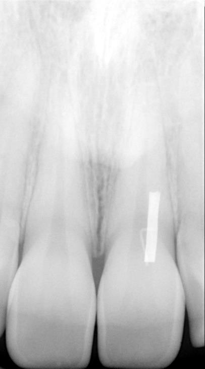 (11, 65) Figura 13- Radiografia numa projeção frontal O passo seguinte envolveu o posicionamento do sistema de paralelização para obter a PPRx, tal como descrito por