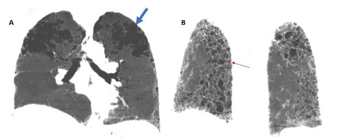 atualização terapêutica Figura 1. (A e B) TC de tórax de paciente com SCFPE (corte transversal). Seta azul e grossa, imagem de enfisema parasseptal.