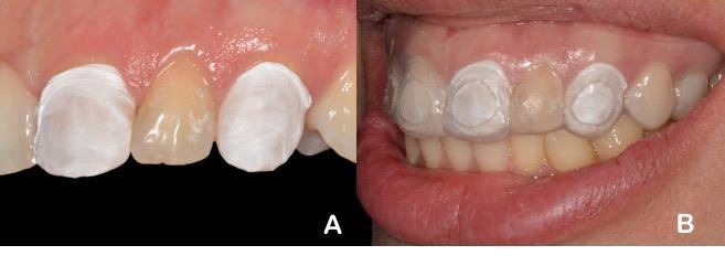 Toda vez que fizesse o uso da moldeira foi indicado que a paciente protegesse os dentes adjacentes com fita de politetrafluoretileno, para evitar o extravasamento de gel para as áreas circundantes