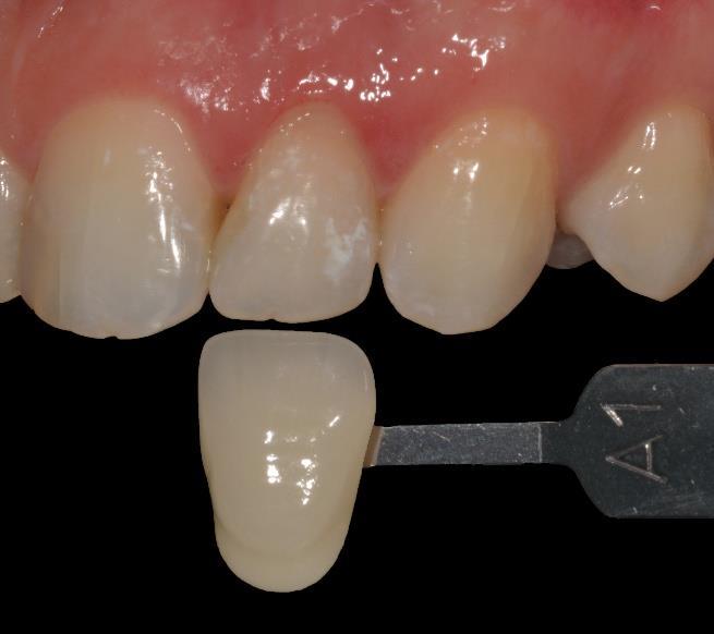 Figura 4: Resultado final após 28 dias de tratamento DISCUSSÃO Visando manter a integridade das estruturas dentárias os tratamentos conservadores sempre são a primeira escolha (5).