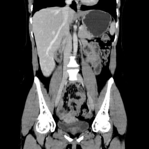 LAPAROSCÓPICAS Hepatocellular adenoma: an excellent indication for laparoscopic liver resection