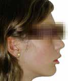 Inclusivamente, em pacientes não tratados foi evidenciada uma diminuição do comprimento do corpo e do ramo mandibular em pacientes que apresentavam uma má oclusão da classe II/divisão I, quando