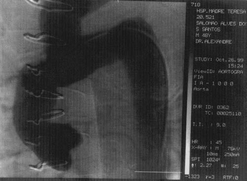 o emprego da prótese intraluminal. Rev Bras Cir Cardiovasc 2001: 136-40. Fig. 2 - Aortografia pós-operatória do mesmo caso.