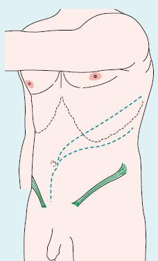 Fig. 2 Incisão retroperitoneal e toraco-retroperitoneal A exposição profunda abdominal é conseguida com a menor manipulação directa possível do AAA na tentativa de minimizar o risco de embolização