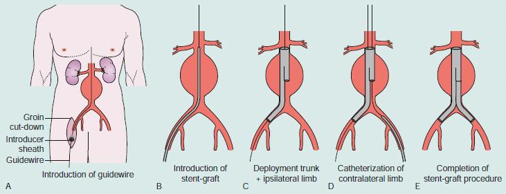 Fig. 7 Etapas de introdução da prótese endovascular A: Após um corte na virilha, um fio-guia é introduzido com uma bainha de inserção B: O sistema é colocado sob controlo fluoroscópico C: O tronco e