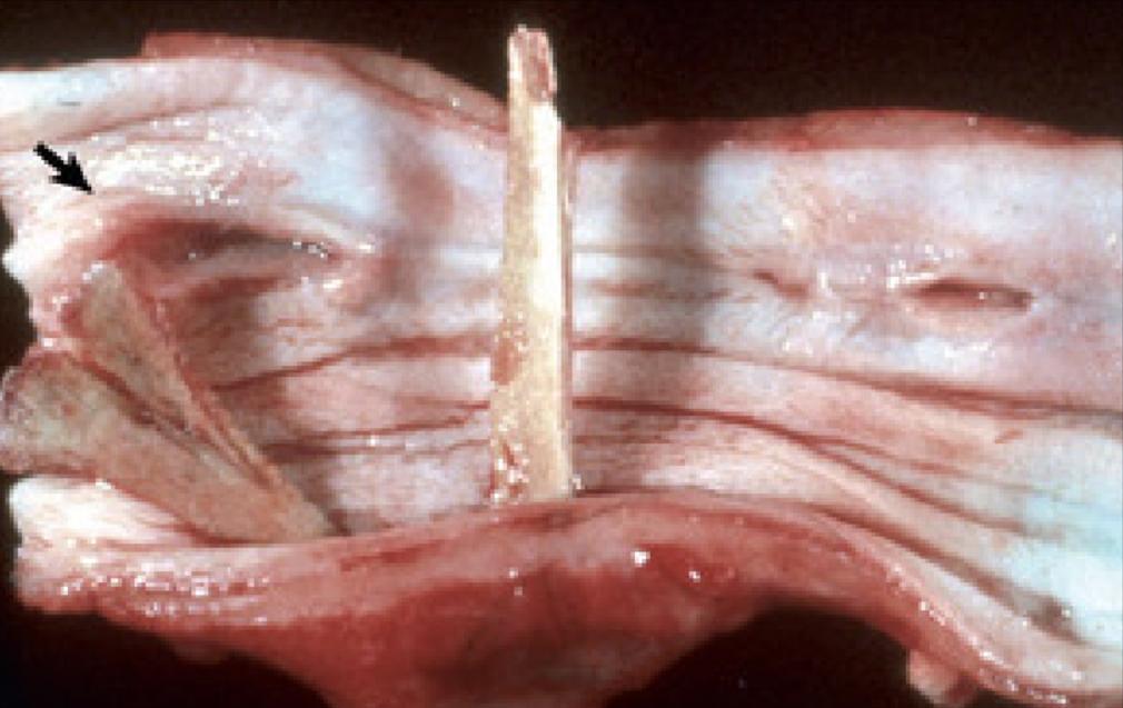9 Figura 2 Úlceras e perfurações, corpo estranho esofágico, cão Esôfago e lesões com osso de galinha. Úlcera profunda (seta), oposta a perfuração.