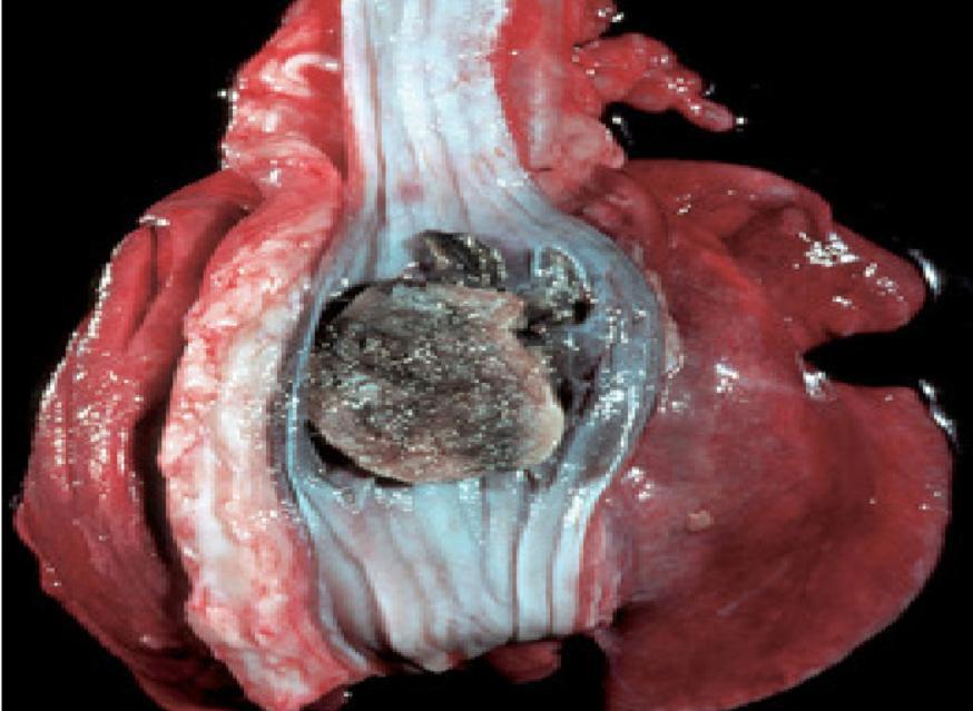 Figura 3 Corpo estranho com necrose, esôfago, cão Osso de pernil, esôfago, cão, dorsal à base do coração, causou dilatação esofágica e necrose por compressão da mucosa