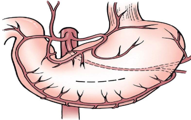 16 Figura 4 Diérese em gastrotomia Local preferencial para incisões em gastrotomia (seta). Fonte: Fossum (2014). Figura 5 Procedimentos de gastrotomia A) Incisão, B) Ampliação, C) e D) Síntese.