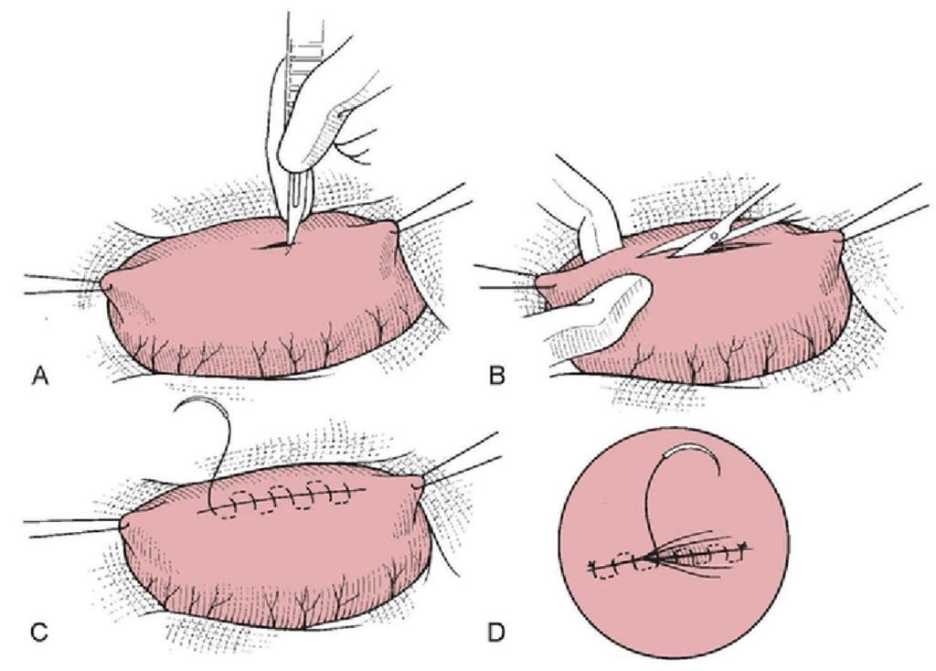 3 Abordagem do esôfago cervical Para abordagem do esôfago cervical (Figura 6), o paciente deve estar posicionado em decúbito dorsal com toalha colocada transversalmente sob o pescoço.
