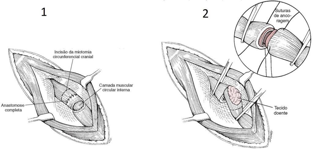 22 extremidade da secção prevista, com a remoção do tecido desvitalizado e com a colocação de suturas para manipulação em cada extremidade.