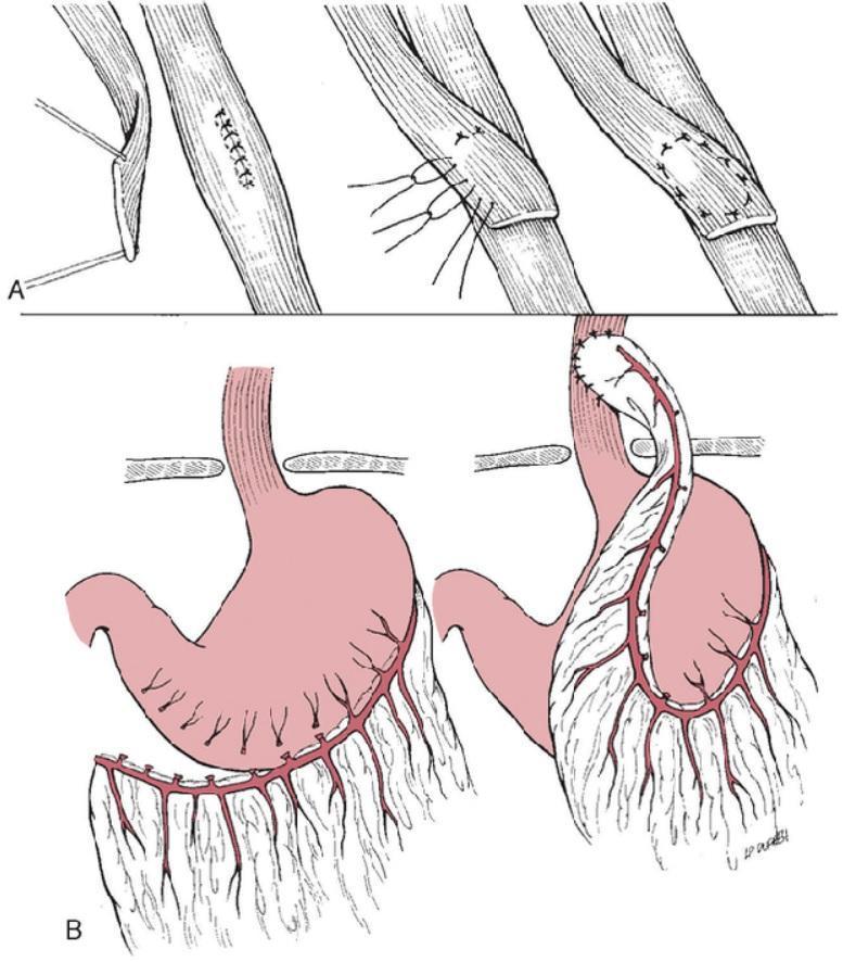 23 5.9 Suporte e Tamponamento Como técnicas complementares de aprimoramento cirúrgico de auxílio cicatricial são úteis o retalho esofágico e o retalho omental para correção do esôfago (Figura 13).