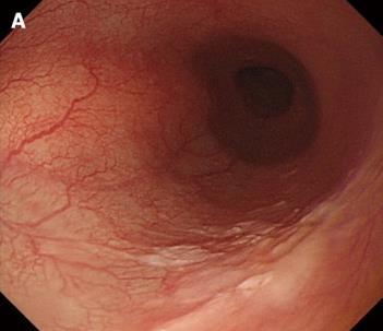 Estadiamento 119 Pacientes Adeno CA T1 Esofagectomia / LDN II Mucosa 54 p Submucosa 65 p p