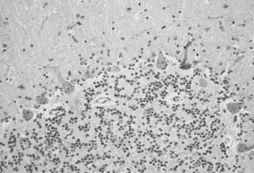 Cromatólise central e vacuolização em neurônios também foi observada em cinco casos no gânglio trigêmeo.