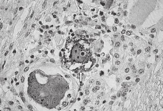 2 3 5 4 Fig.1. Marcações de antígeno da raiva em formações de agregados de grânulos no mesencéfalo. Imuno-histoquímica, método biotina-estreptavidina-peroxidase, obj.40x. Fig.2. Imunomarcação do antígeno da raiva em forma de corpúsculos de inclusão no pericário (seta) de neurônio da ponte.