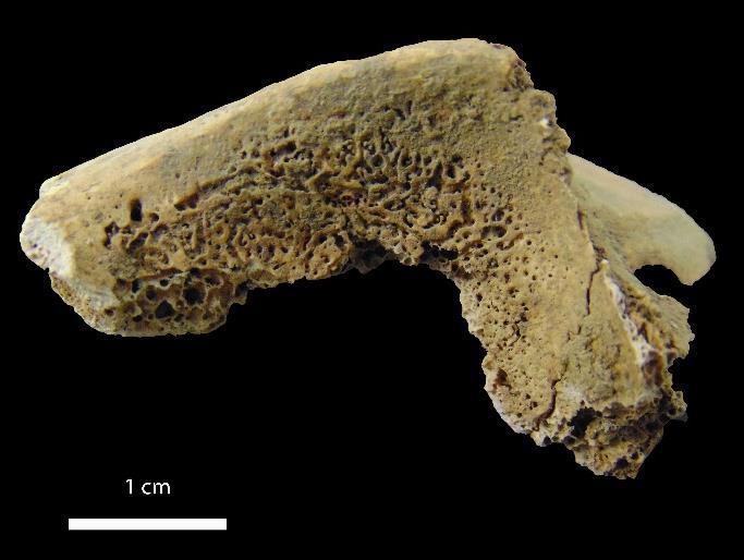 Como foi referido anteriormente, a cribra femoralis e humeralis desenvolvem-se em regiões metafisárias, como zonas de crescimento estas apresentam normalmente alguma porosidade durante o crescimento,