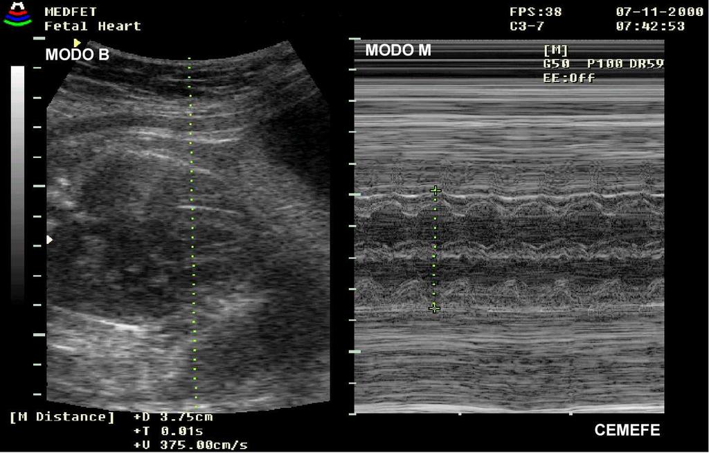 FIGURA Ecocardiograma modo M dos ventrículos fetais para medida do DBVE.