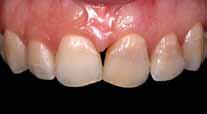 nos dentes mais afetados (Fig. 4) em 3 aplicações de 10 minutos.