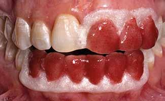 mais afetados, e por mais 2 meses em todos os dentes (Fig. 5).