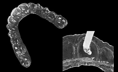 Figura 1 - Aspecto inicial do manchamento: observa-se que um grupo de dentes é mais
