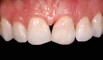 Figura 4 - Aplicação do gel clareador (peróxido de hidrogênio 38%) nos dentes mais