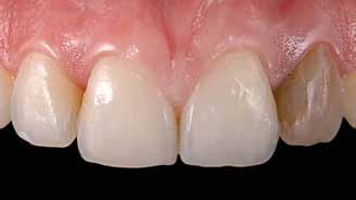 Clareamento dentário: terapias modificadas para