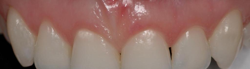 FIGURA 13 Fotografia dos dentes ântero-superiores. Detalhe do posicionamento da área de reflexão.