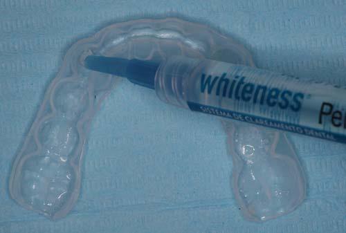 Também foi distribuída uma escova e um creme dental livre de agentes clareadores para cada paciente, a fim da padronização do regime de higiene oral. Figura 13 Prova da moldeira.