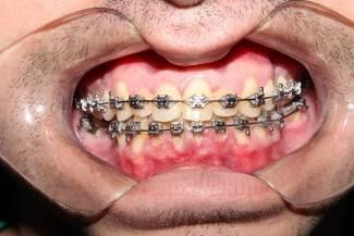 alinhamento e nivelamento dos dentes superiores e inferiores, com uma boa relação de linha