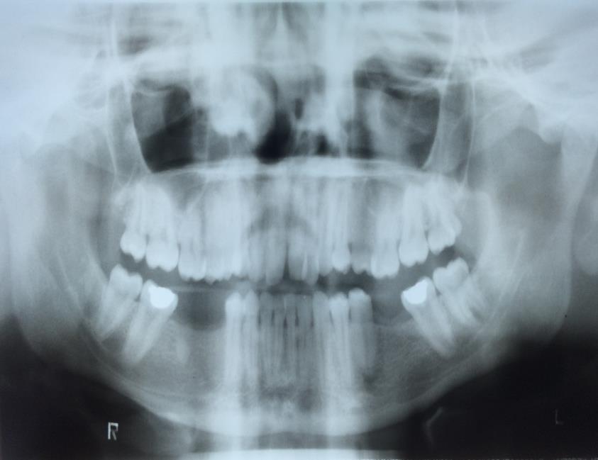 Revista BioSalus 2 (2016) 1-15 7 Imagem 1: Teleradiografia lateral - PACI1 Imagem 2: Panorâmica padrão PACI1 Diante do diagnóstico, foi indicado a utilização de um autoligável, neste caso de um Roth