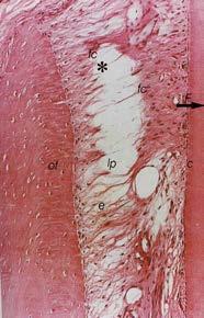 fibras; - Aposição de osteóide na superfície óssea.
