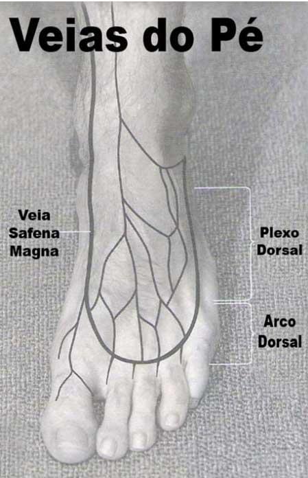 Região dos membros inferiores (veias de última escolha): Veia safena magna Materiais: Bandeja; Dispositivo intravenoso, compatível com o acesso venoso do paciente: TIPOS Agulhado (scalp) 27, 25, 23 e