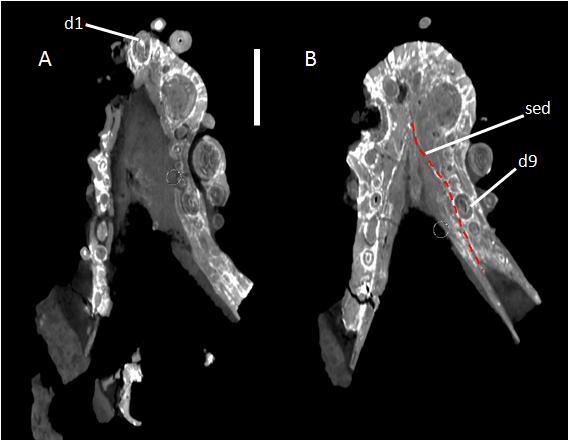 Material e métodos mandíbula se encontra adpressa, impossibilitando a observação superficial de tal angulação. Porém, com as imagens obtidas a partir da tomografia computadorizada (C.T.