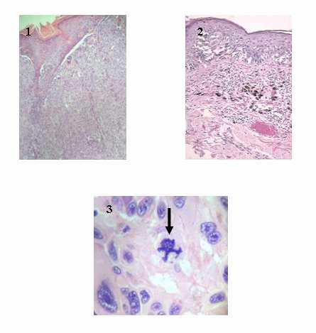 43 FIGURAS 1, 2 E 3 - FOTOMICROGRAFIAS EXEMPLIFICANDO MELANOMA GROSSO E FINO DE ACORDO COM A ESPESSURA TUMORAL E NÚMERO DE MITOSES (VARIÁVEIS