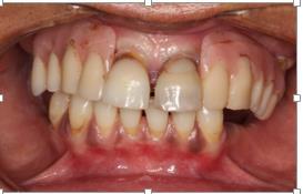 totais mandibulares e maxilares, enfrentam alguns problemas como a instabilidade das próteses, dor na cavidade oral e penetração do alimento entre a base da prótese e a mucosa do rebordo alveolar