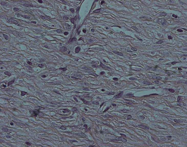 tecido conjuntivo e presença de fibras colágenas; b) aspecto histológico caracterizando menor