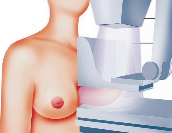 64 sic ginecologia 1. Métodos de imagem Figura 1 - Procedimento mamográfico Figura 2 - Mamografia normal (BI- -RADS 1) Pergunta 2013 - SUS-BA 1.