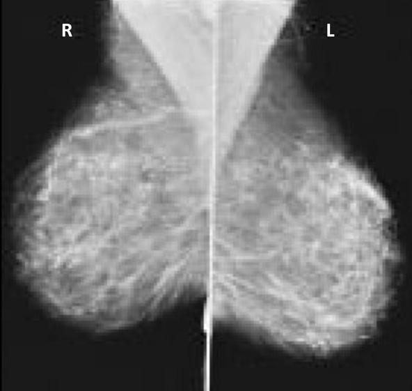 ressonância magnética das mamas Resposta no final do capítulo A - Mamografia A mamografia é o único exame comprovadamente eficaz para o rastreamento de lesões da mama.