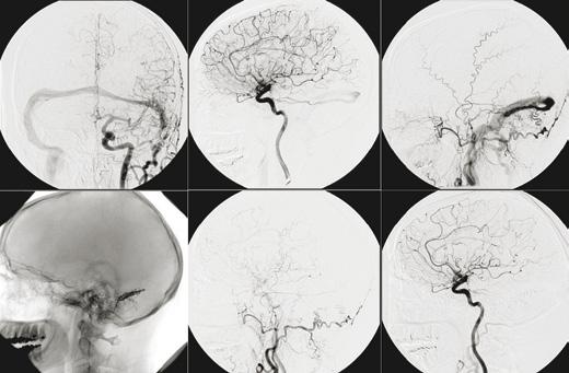 92 lateral and cavernous sinus. For the lateral sinus group, the first choice is to perform arterial embolization with glue, mainly ONYX (EV3).