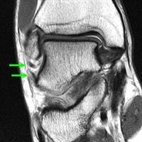 Enquanto o Raio-X é realizado principalmente para descartar fraturas e lesões da sindesmose, a ressonância magnética confirma o diagnóstico, quando realizada após a reabsorção do edema A ressonância