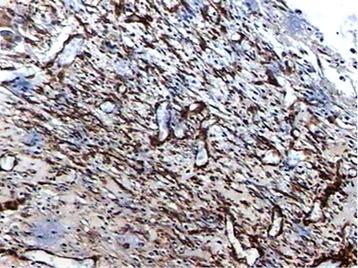 39 Figura 21: Fotomicrografia do grupo GI (7 dias). A imunomarcação por a-sma mostrou uma presença moderada de miofibroblastos (Streptavidin-Biotin immunoperoxidase; magnificação 40 X).