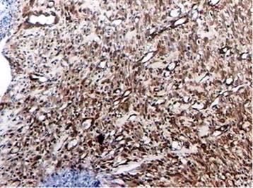 45 Figura 28: Fotomicrografia do grupo GIV (14 dias) mostrou presença marcante de miofibroblastos (Streptavidin-Biotin immunoperoxidase; magnificação 40 X).