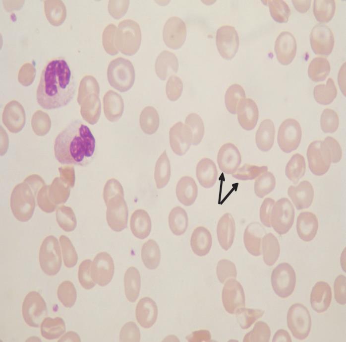 anemia falciforme?