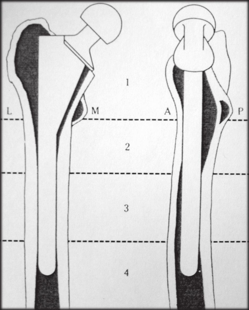 292 (ACS acetabular cup system), isto é, absolutamente hemisférico e com superfície metálica porosa. Foram implantados 11 modelos do tipo TSC não modulares, 22 TSC modulares e 11 do tipo ACS.