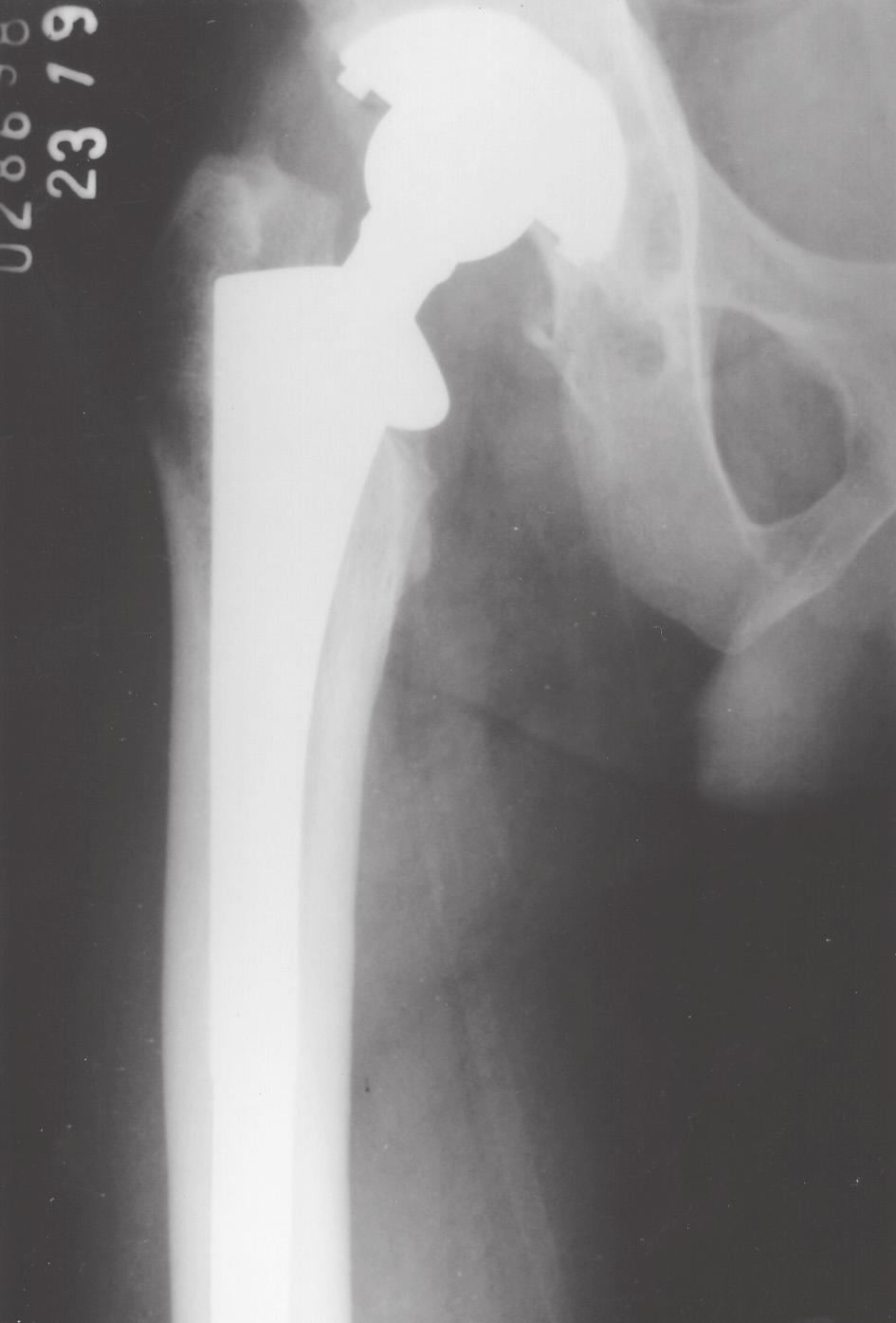 Stress shielding : avaliação radiográfica após seguimento a longo prazo 293